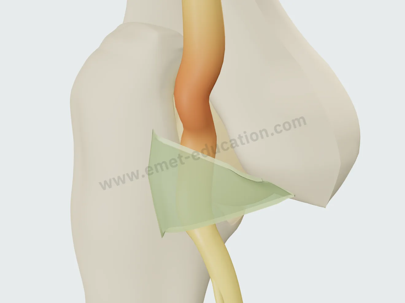 Moderate compression: red pseudoneuroma above the band, nerve flattened beneath it.