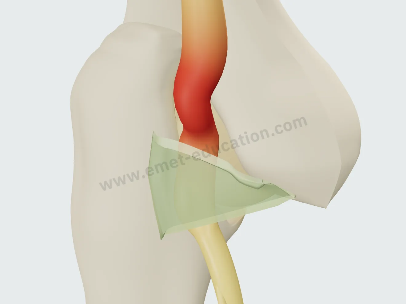 Severe compression: nerve markedly swollen and red above the ligament.