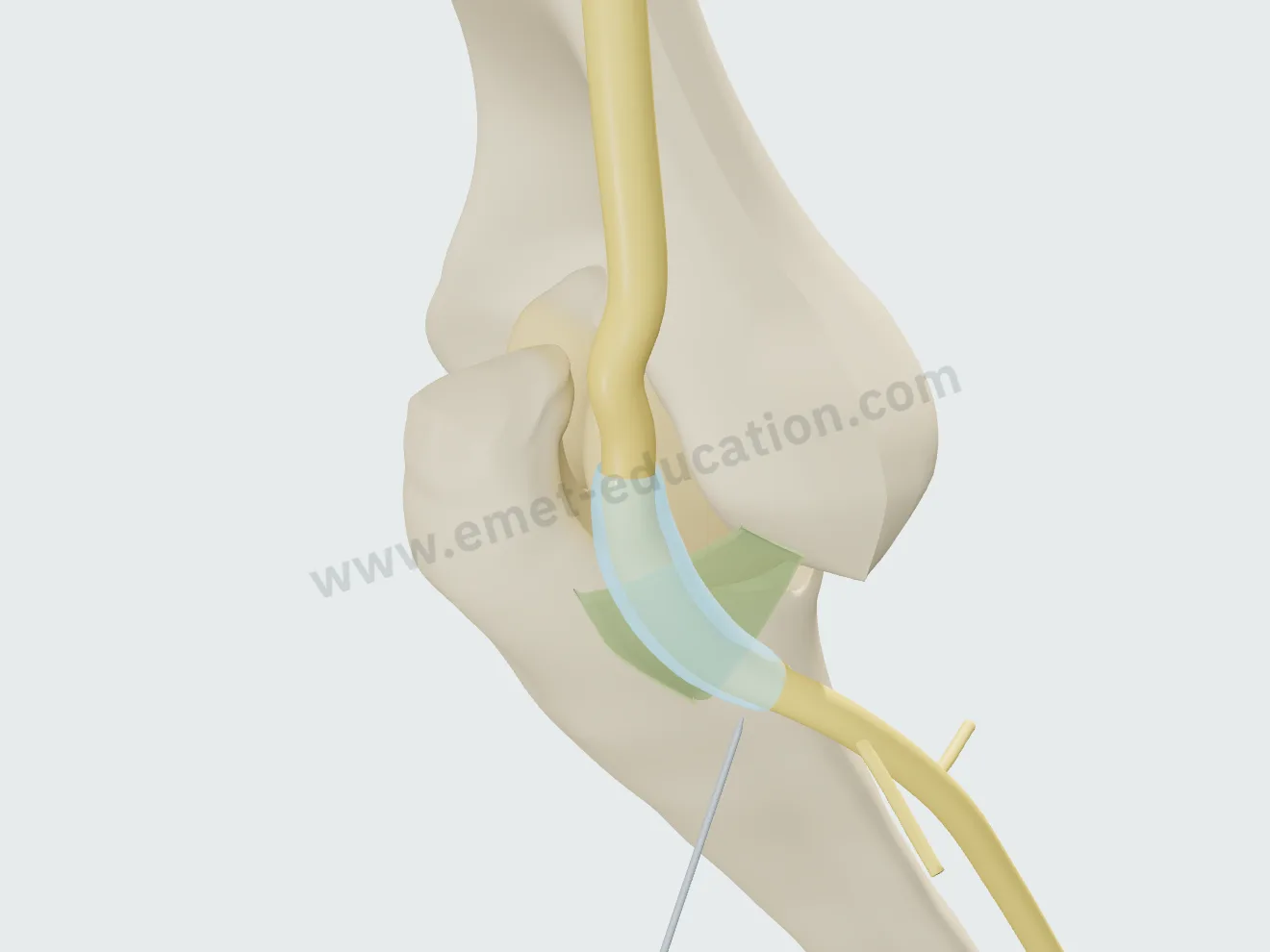 Injection, step 2: the medication spread as a sleeve around the nerve, under the band.