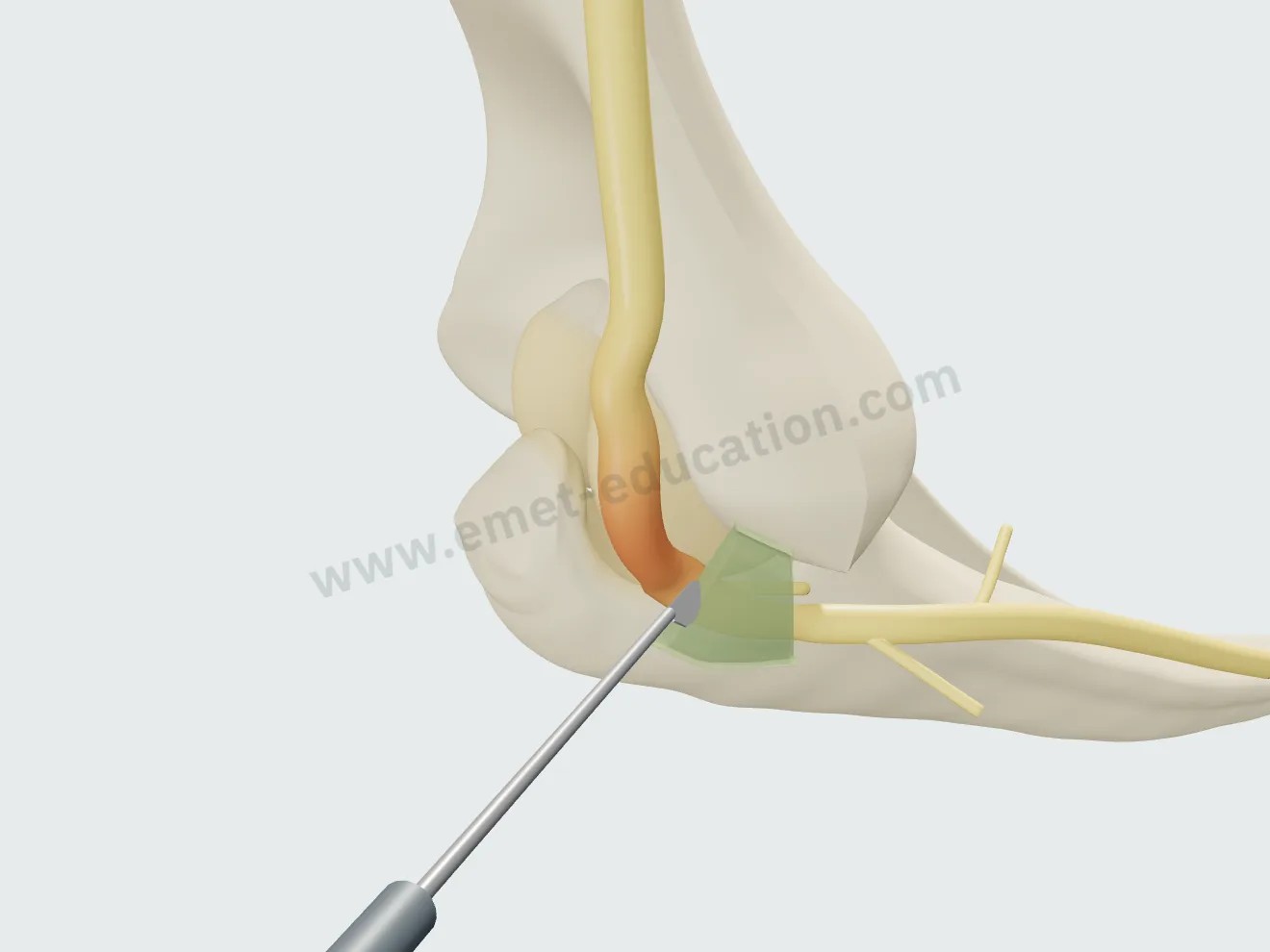 Neurolysis, step 1: the nerve exposed, the scalpel over Osborne's ligament.