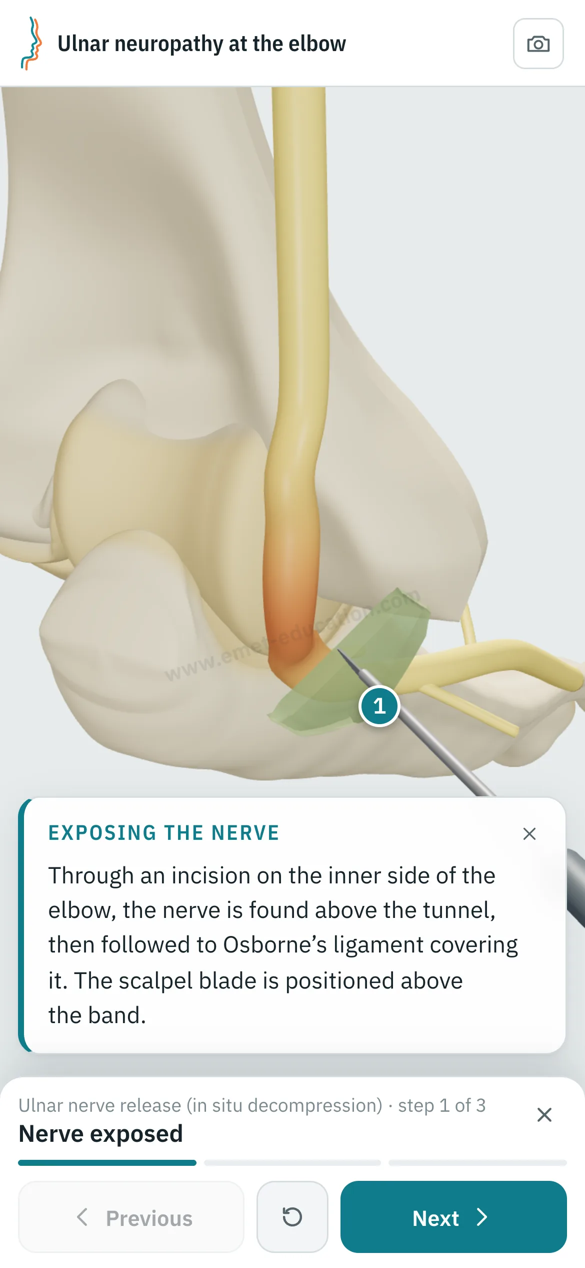 Patient view on a phone: the ulnar nerve release replayed step by step.
