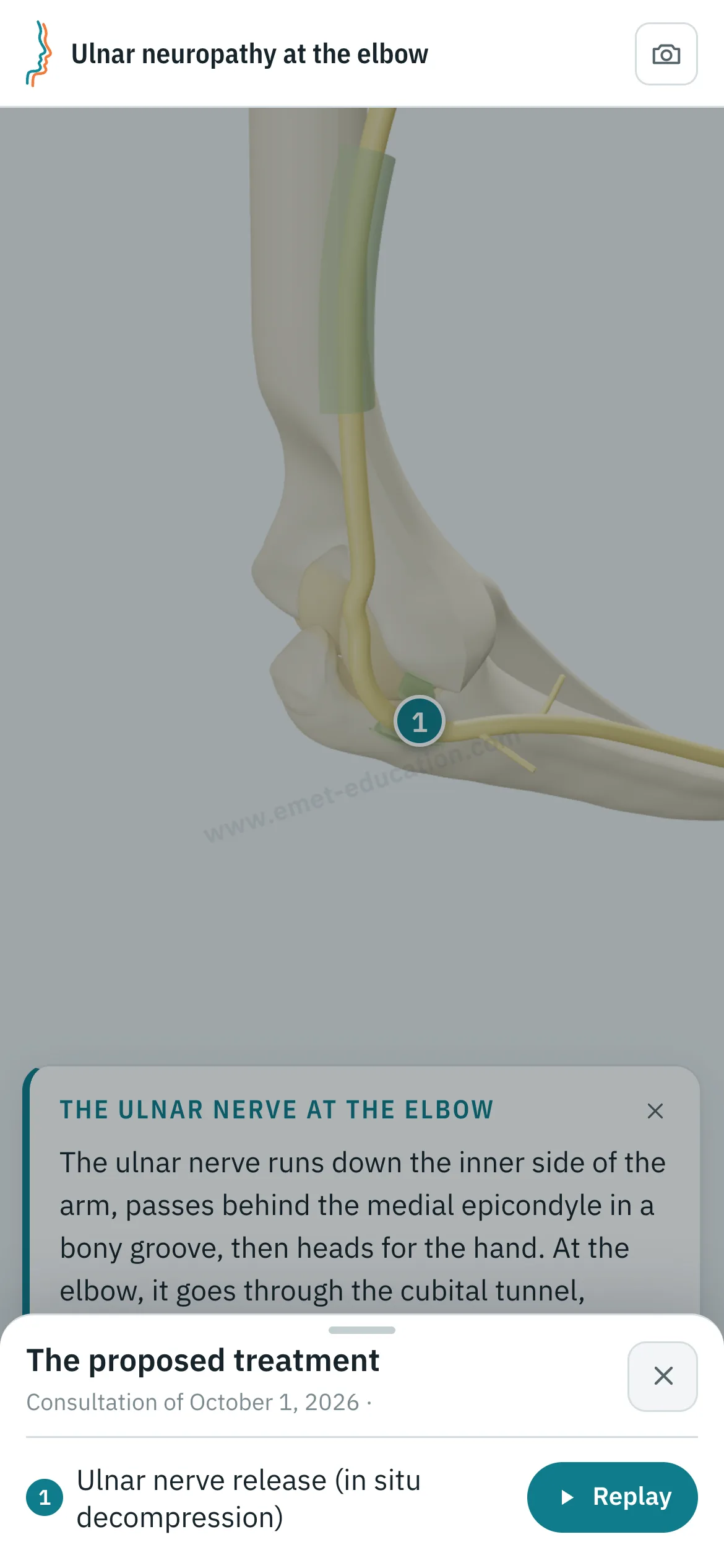 Patient view on a phone: the elbow after ulnar nerve release, and the “The proposed treatment” panel open, with the “Replay” button.