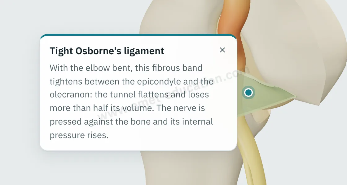 Explanation bubble “Tight Osborne's ligament” shown after tapping the ligament, over the compressed nerve.