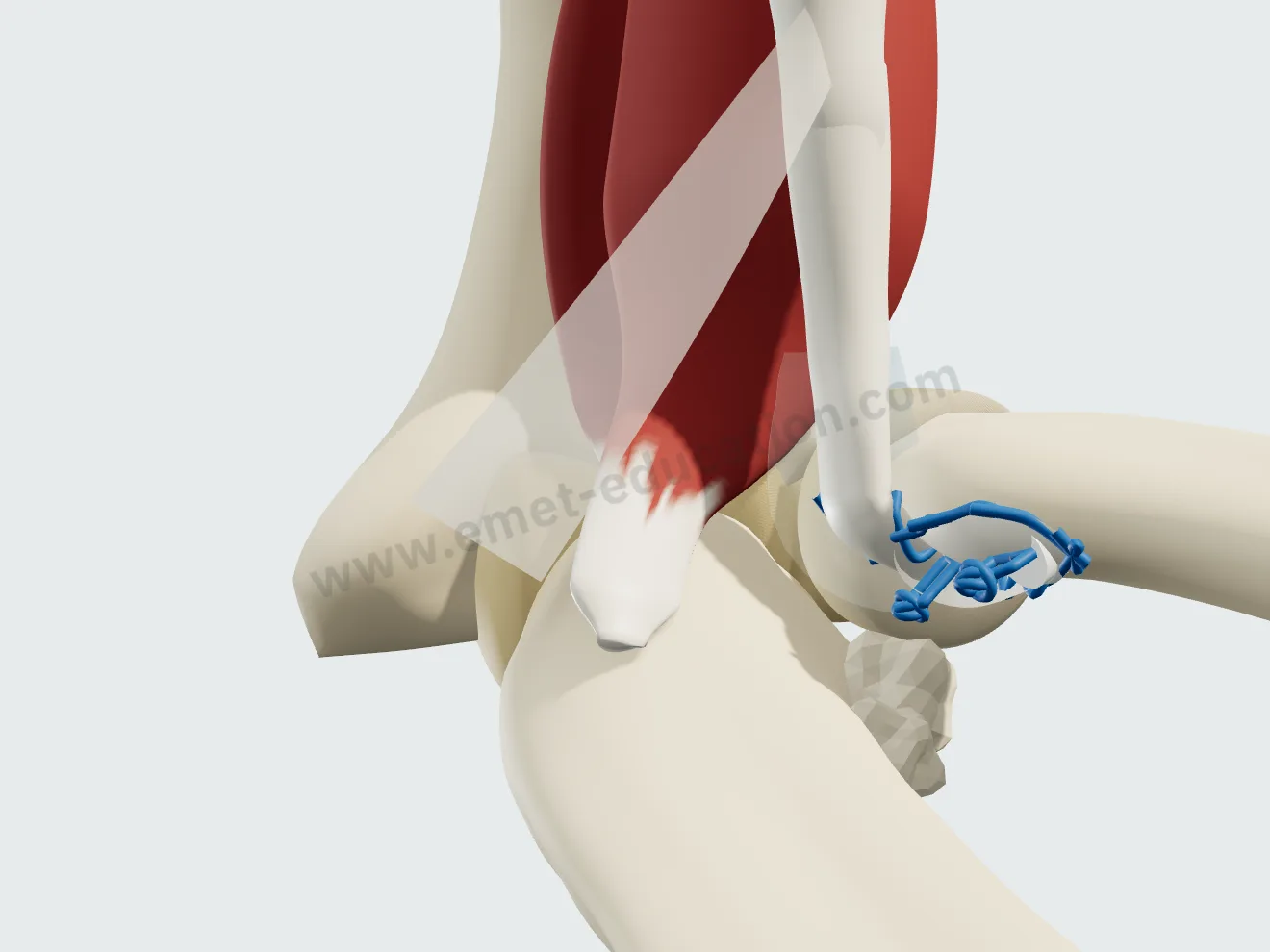 Heterotopic ossification in the interosseous space, between radius and ulna.