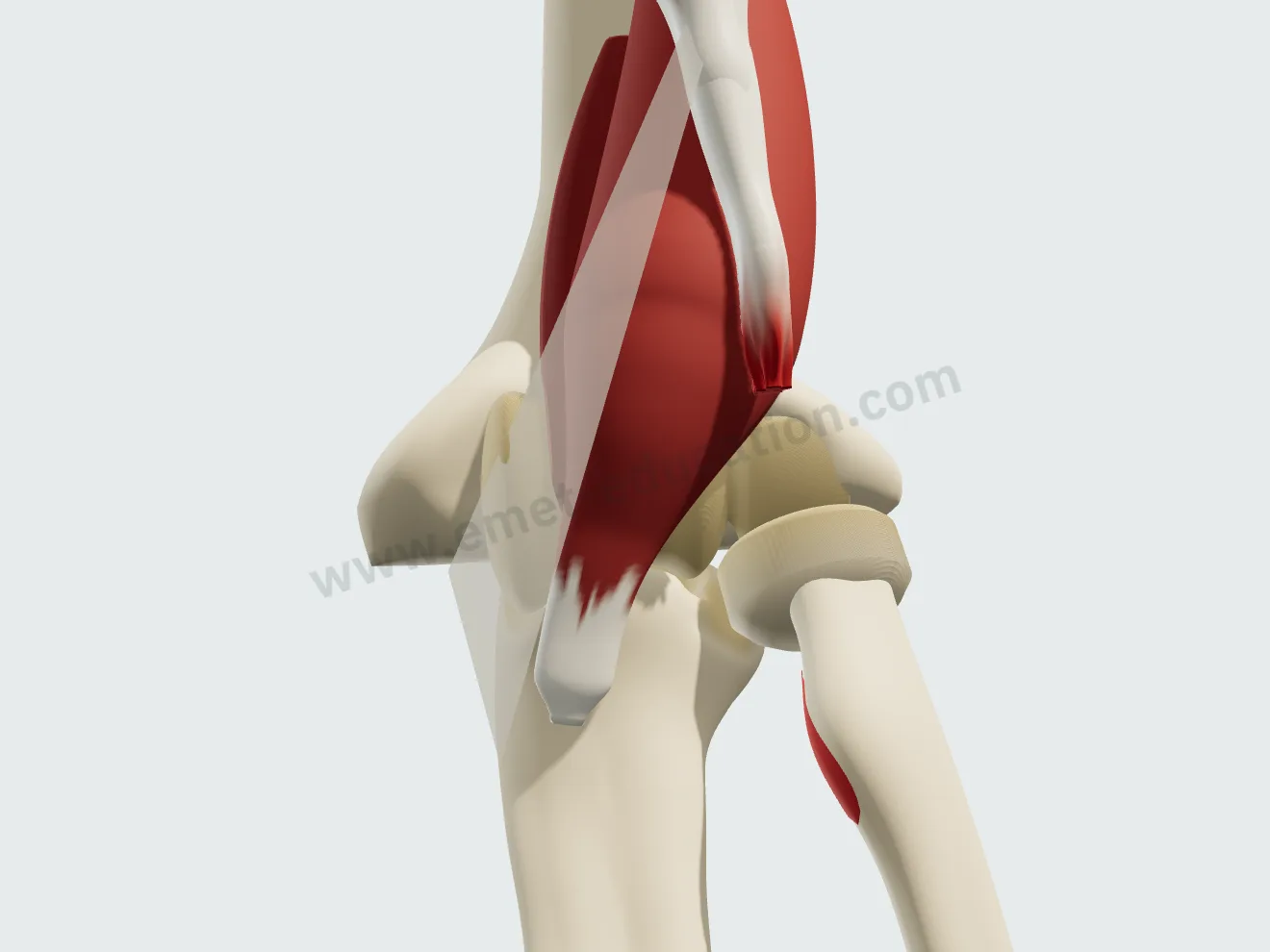 Nonoperative treatment, step 1: the torn, retracted tendon.