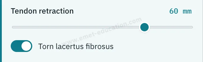 Model panel: 60 mm retraction, “Torn lacertus fibrosus” on.