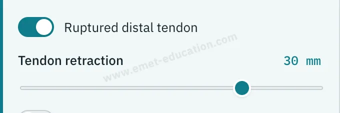 Model panel: “Ruptured distal tendon” on, 30 mm retraction.