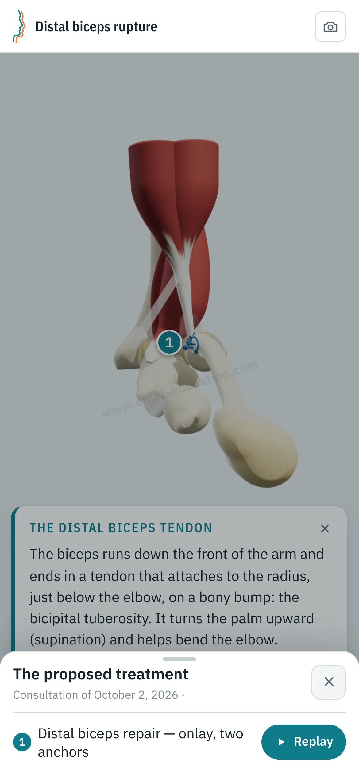 Patient view on a phone: the tendon reattached with anchors, and the “The proposed treatment” panel open, with the “Replay” button.