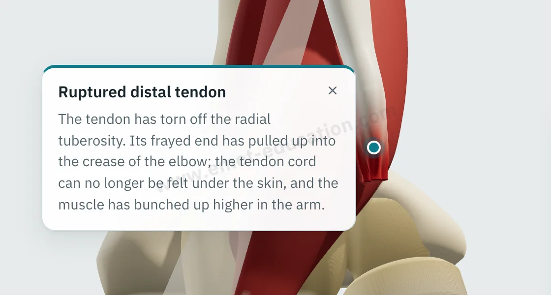 Explanation bubble shown after tapping the end of the torn tendon, above the elbow crease.