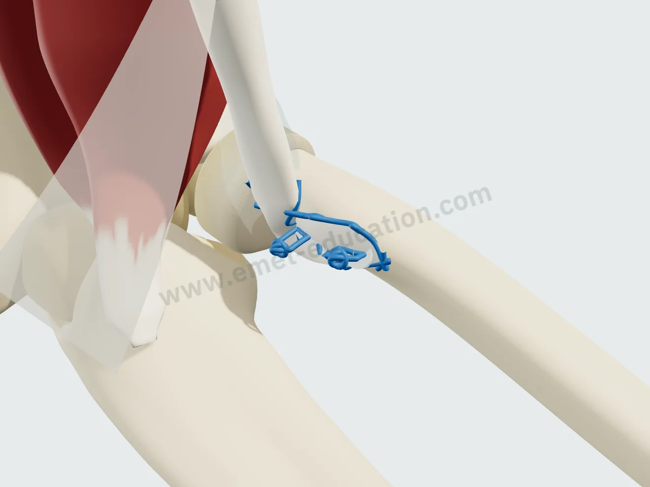 Repair, step 4: the anchor sutures pass through the tendon and are tied over it.