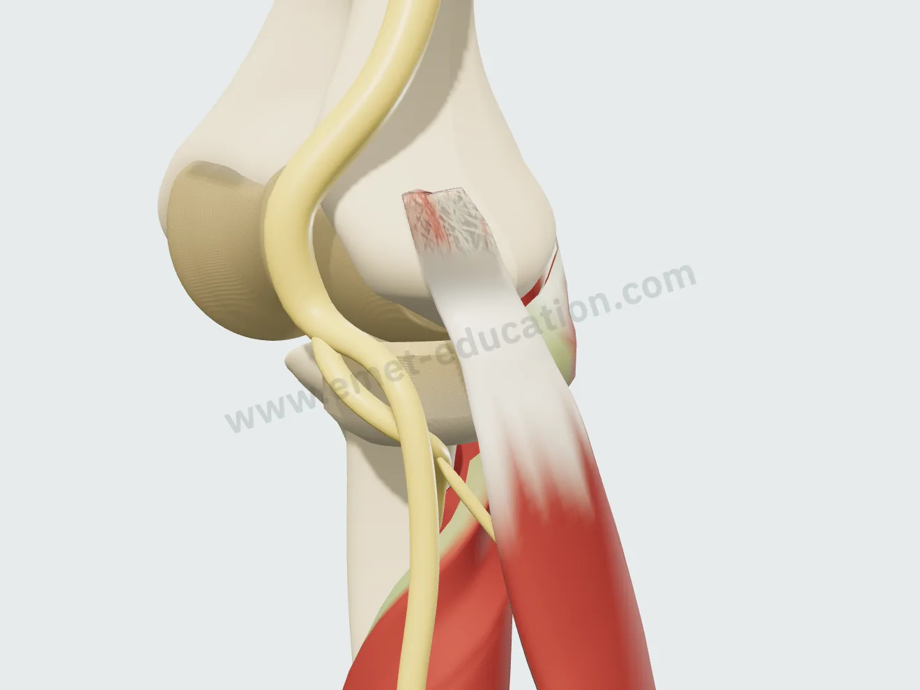 Open surgery, step 1: the extensor carpi radialis brevis origin exposed, its lesion visible.