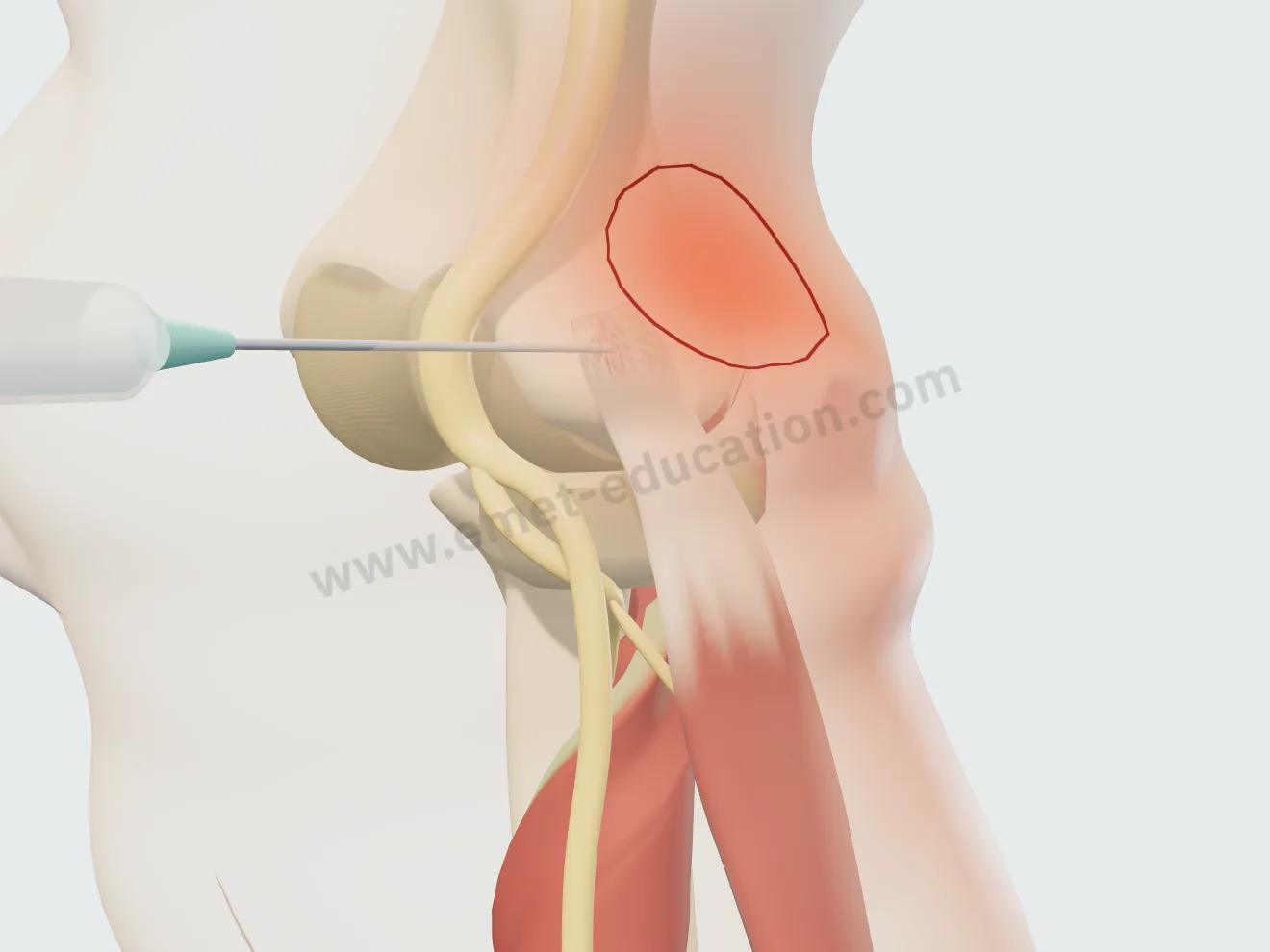 Injection, step 1: the needle entering from the lateral elbow, stopped against the tendon.