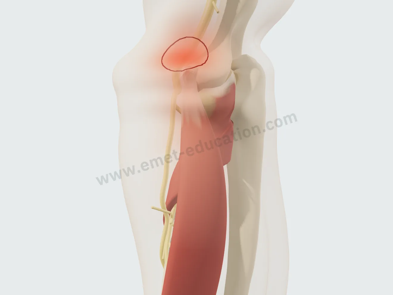 Partial tear: a wider painful area, radiating along the extensors.