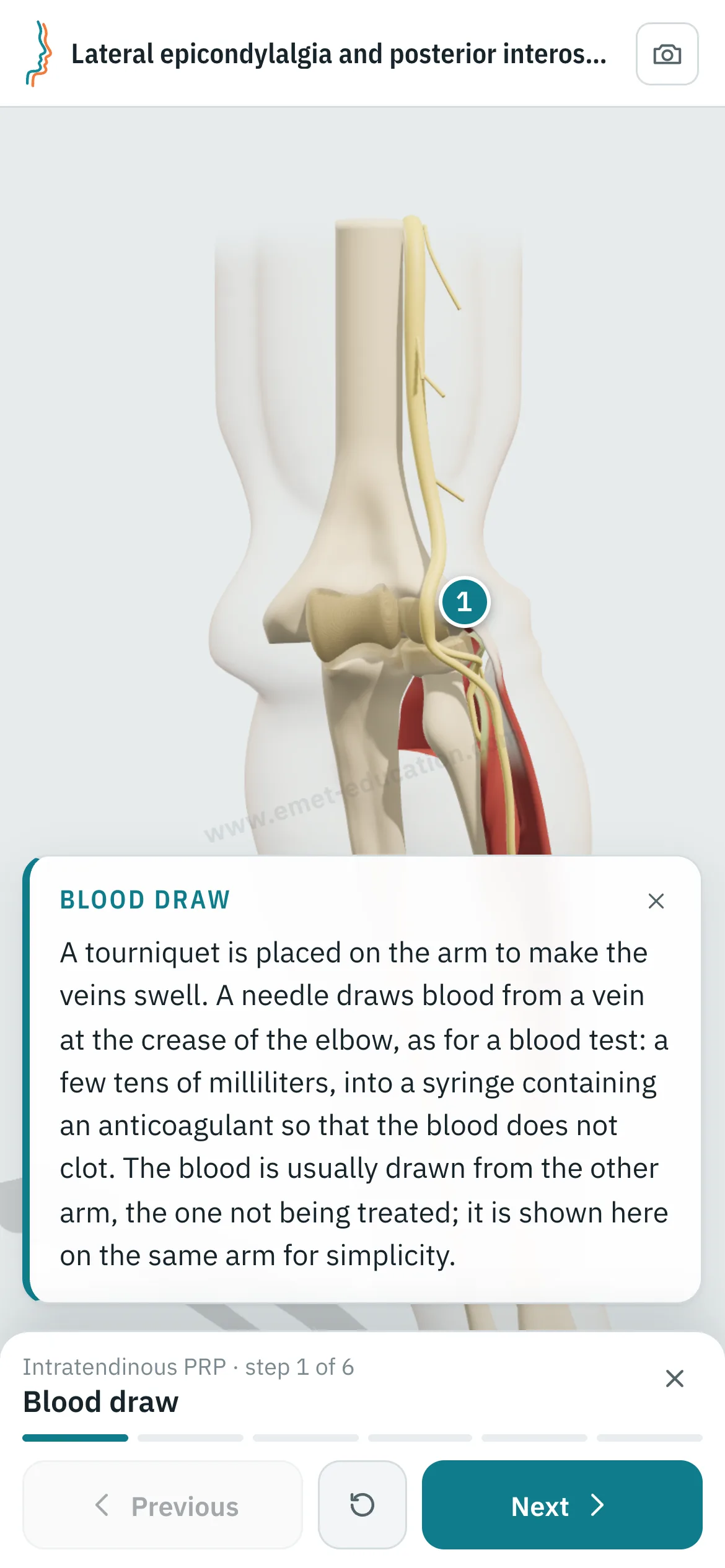 Patient view on a phone: the intratendinous PRP replayed step by step.