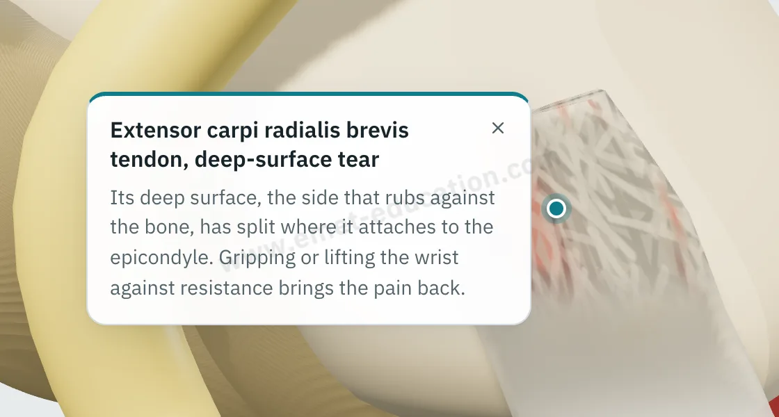 Explanation bubble “Extensor carpi radialis brevis tendon, deep-surface tear” shown after tapping the extensor carpi radialis brevis tendon.
