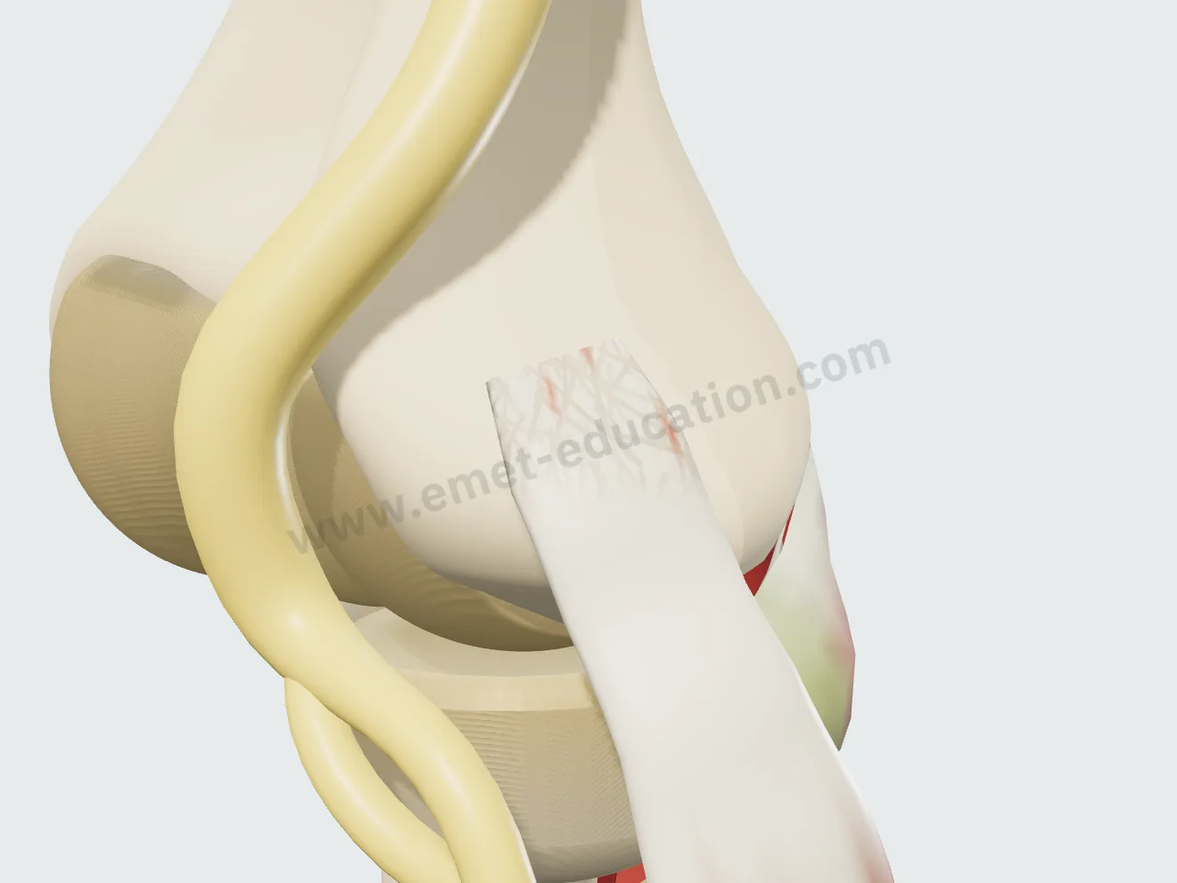 Tendinosis: the extensor carpi radialis brevis origin thickened, dull, dotted with neovessels.