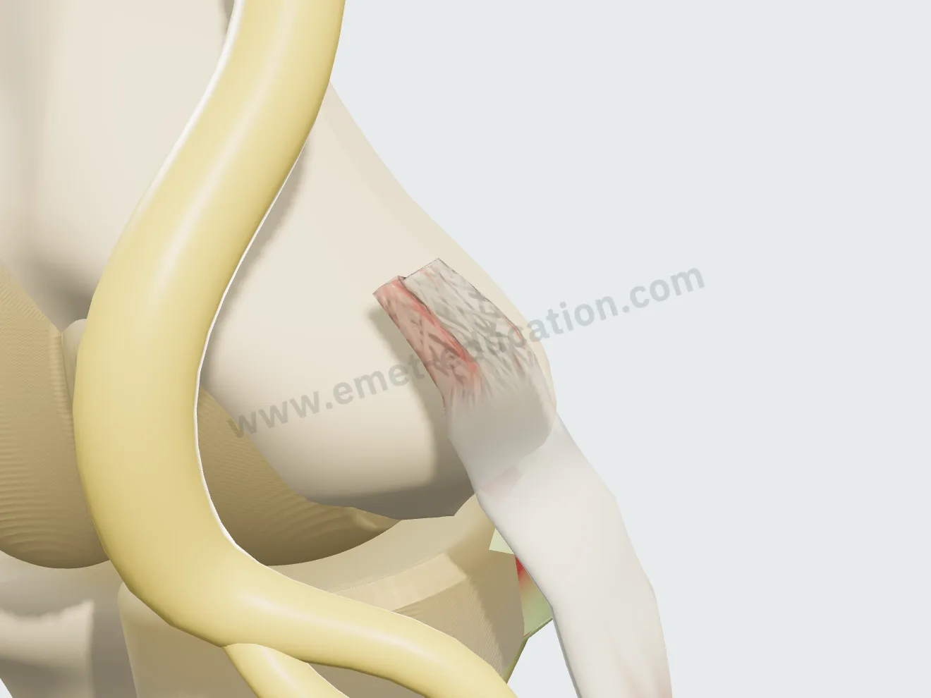 Partial tear: the anterior part of the footprint detached from the epicondyle, with red edges.