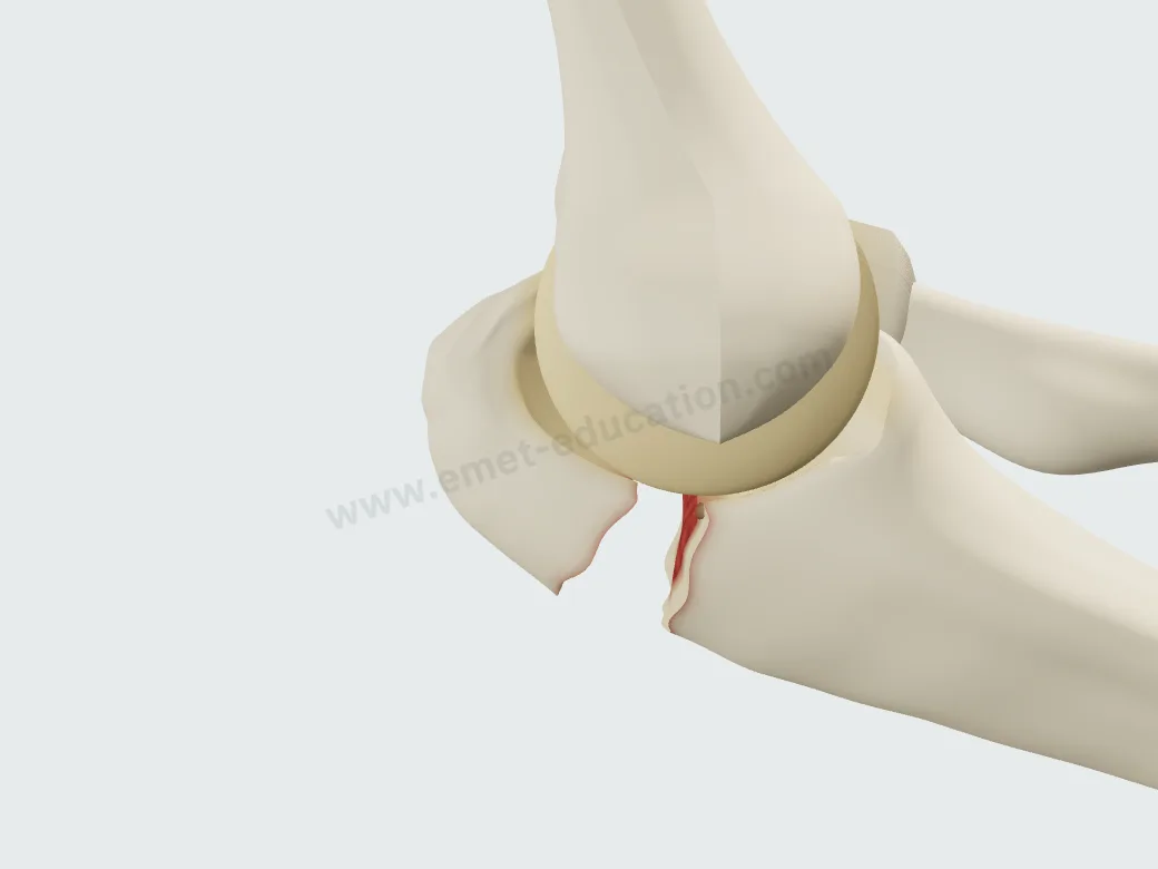 Displaced olecranon fracture, stable elbow (Mayo IIA): the proximal fragment pulled proximally.