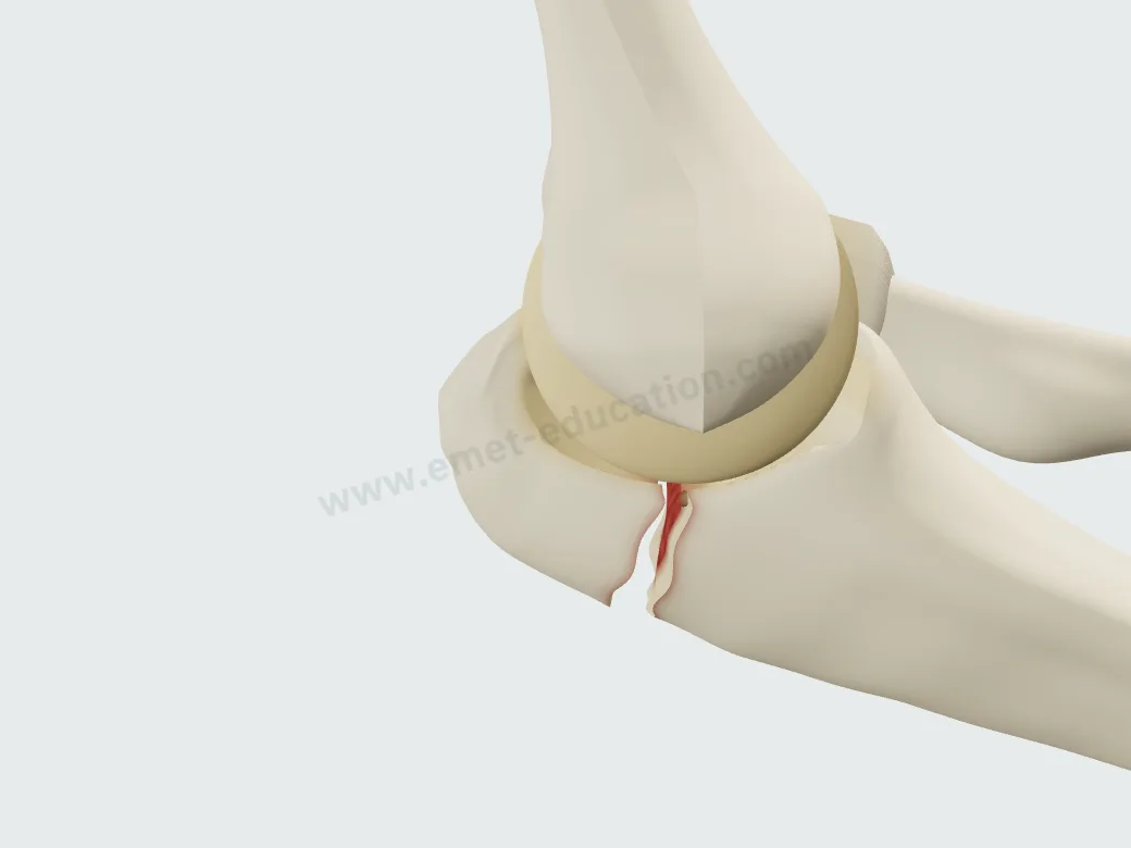 Minimally displaced olecranon fracture, 4 mm gap.