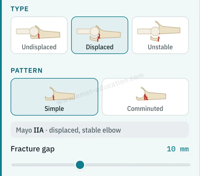 Model panel: fracture type (undisplaced, displaced, unstable), pattern (simple, comminuted), Mayo IIA classification, 10 mm fracture gap.