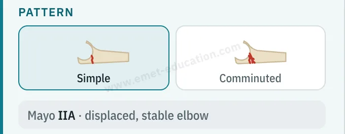Model panel: simple or comminuted pattern, Mayo IIA classification.