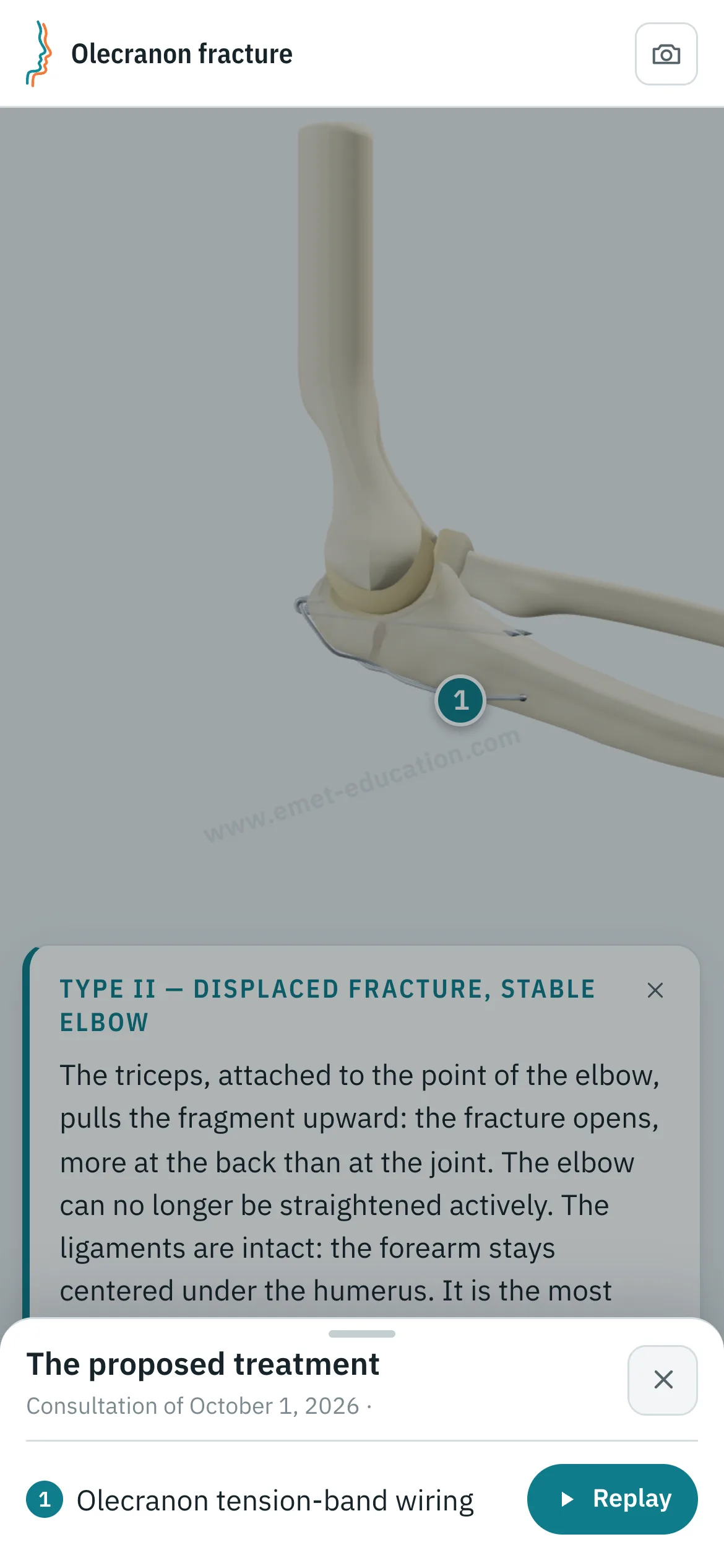 Patient view on a phone: the elbow after tension-band wiring, the card “Type II — displaced fracture, stable elbow,” and the “The proposed treatment” panel open: olecranon tension-band wiring, “Replay” button.
