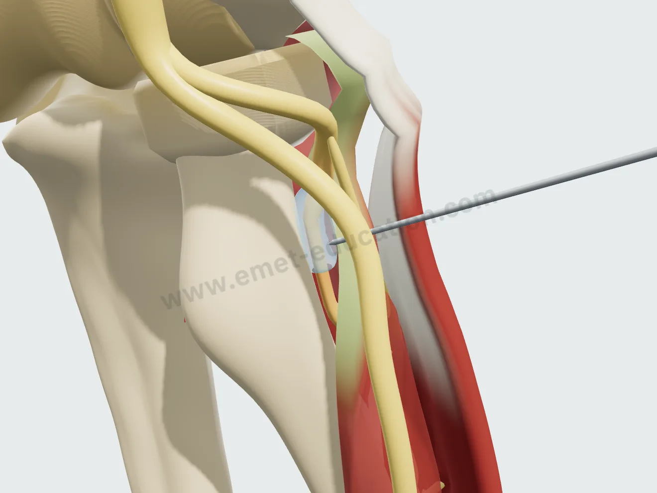 Injection, step 2: the bluish medication wrapping around the nerve as a sleeve.