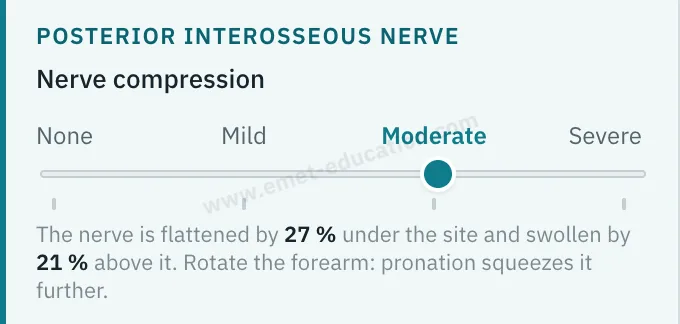 Model panel: the posterior interosseous nerve compression slider, set to “Moderate”, with the measurement read below it.