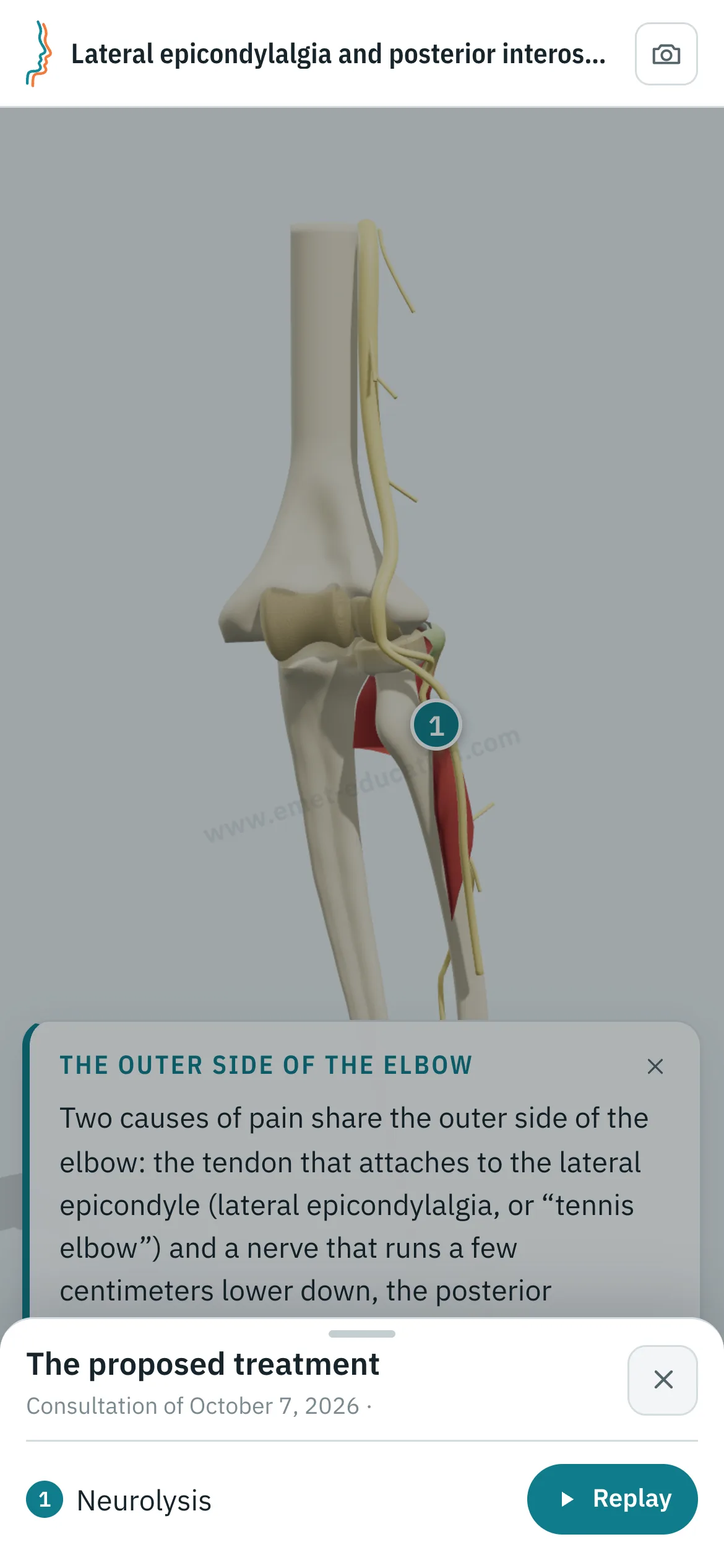 Patient view on a phone: the elbow after posterior interosseous nerve release, and the “The proposed treatment” panel open, with the “Replay” button.