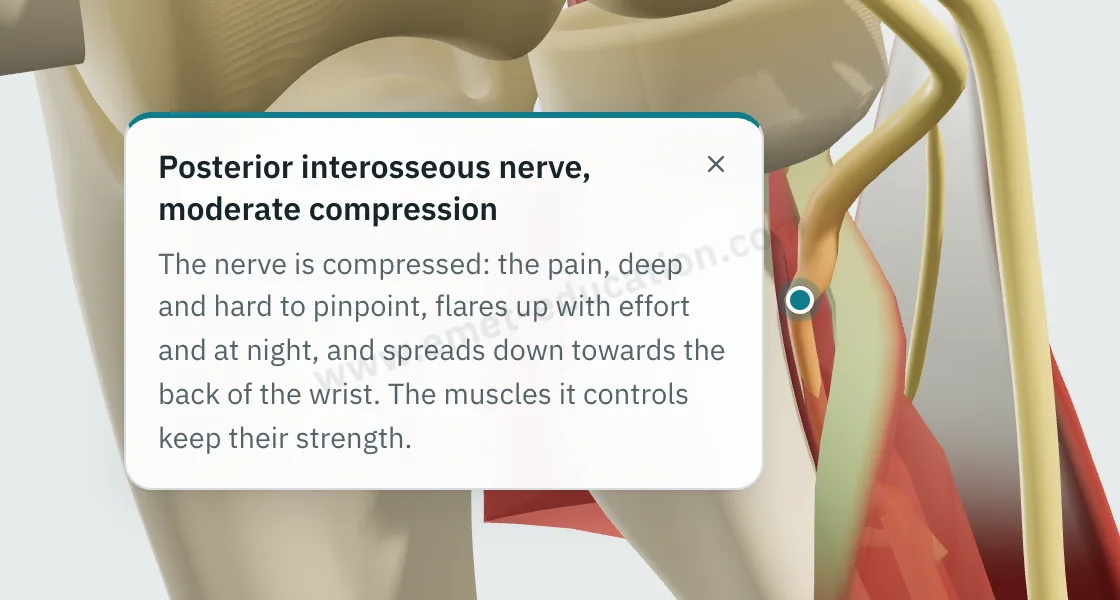 Explanation bubble “Arcade of Frohse” shown after tapping the arcade, over the compressed nerve.