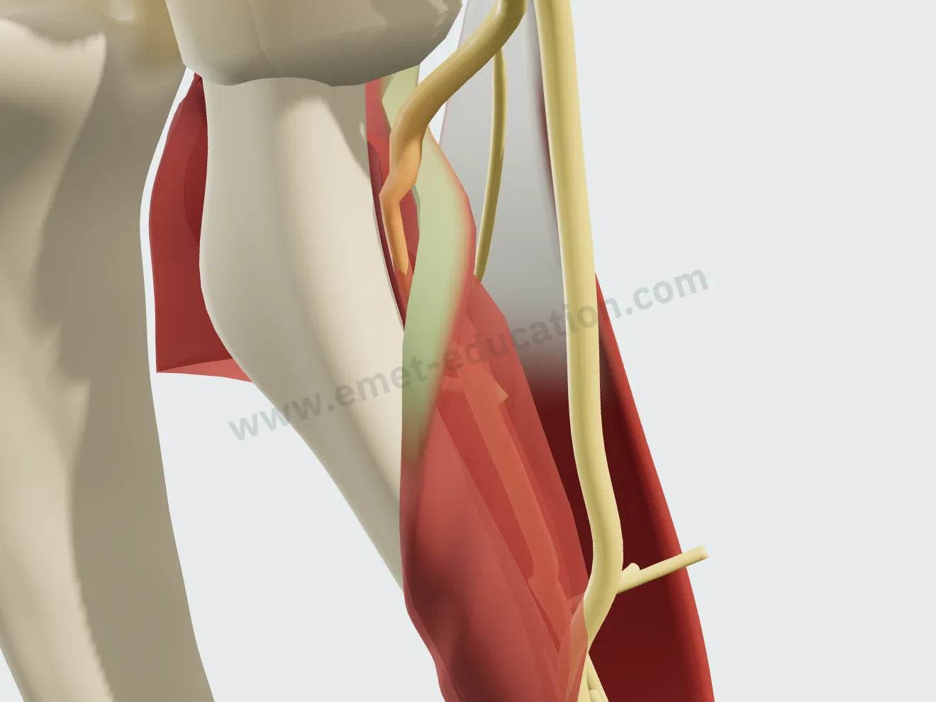 Moderate compression under the arcade of Frohse: the nerve flattened at the upper edge of the supinator.