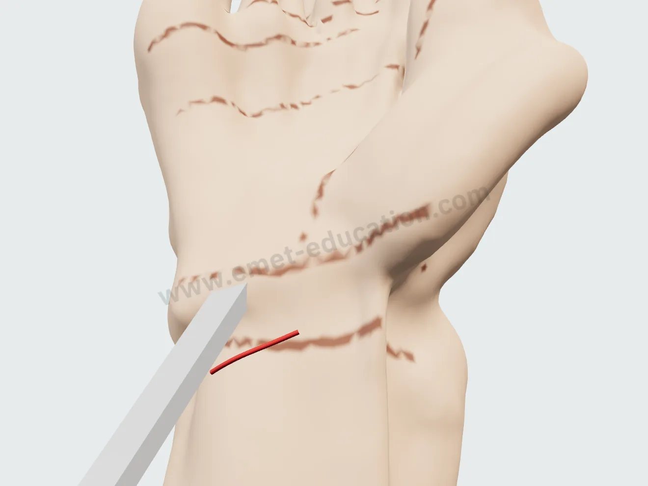 Endoscopic release, step 1: the cannula slid under the ligament, at the proximal wrist crease.