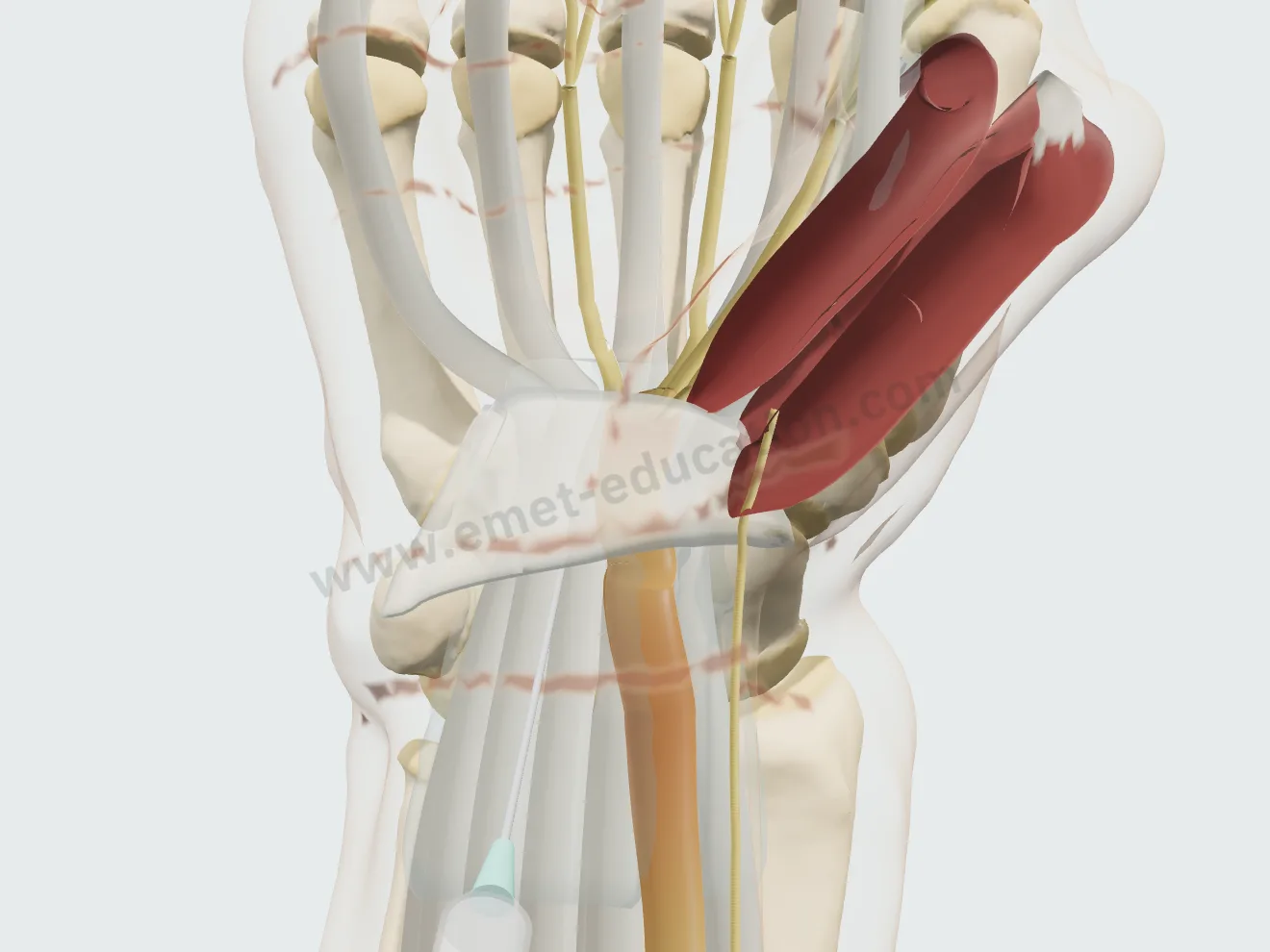 Injection, step 1: the needle at an angle in the tunnel, at the ulnar edge of the nerve.