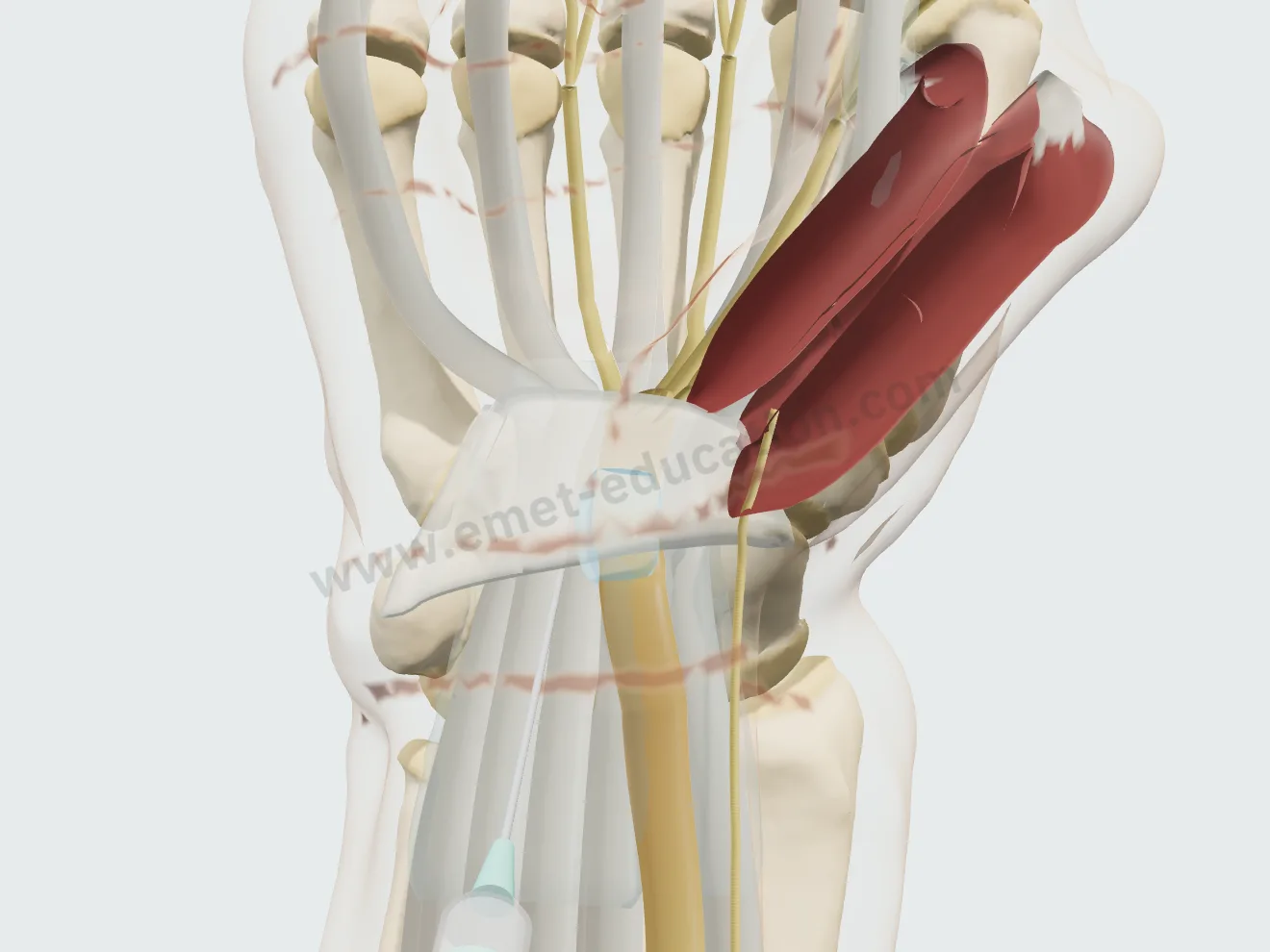 Injection, step 2: the medication spread as a sleeve around the nerve.