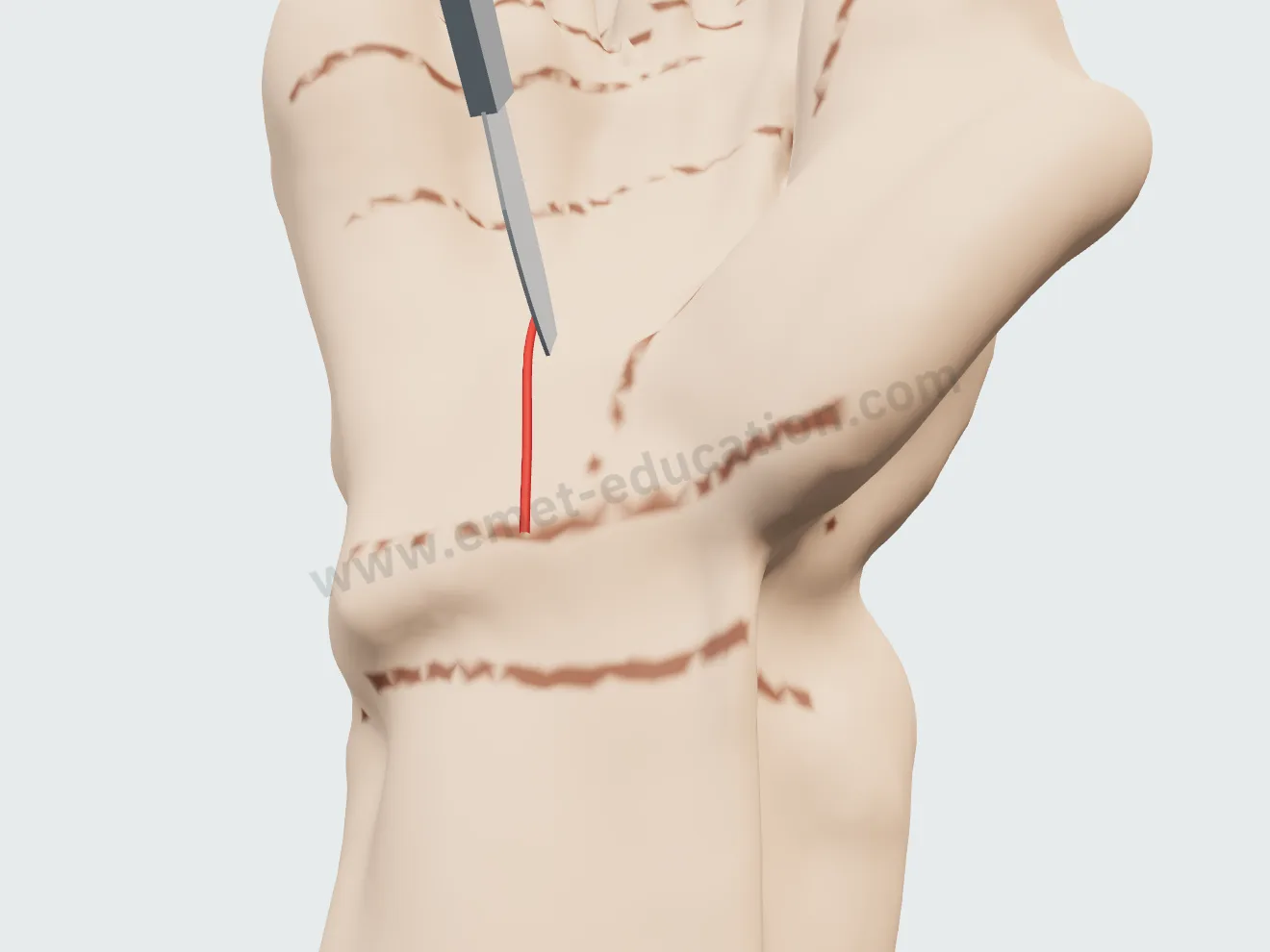 Open release, step 1: the palmar incision, in line with the ring finger.