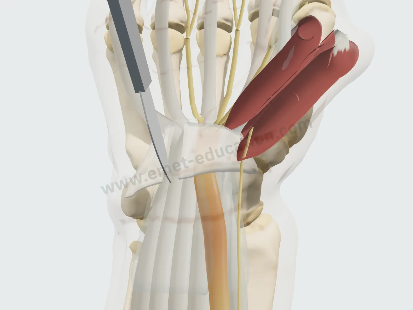 Open release, step 2: the ligament divided at the ulnar edge of the nerve.