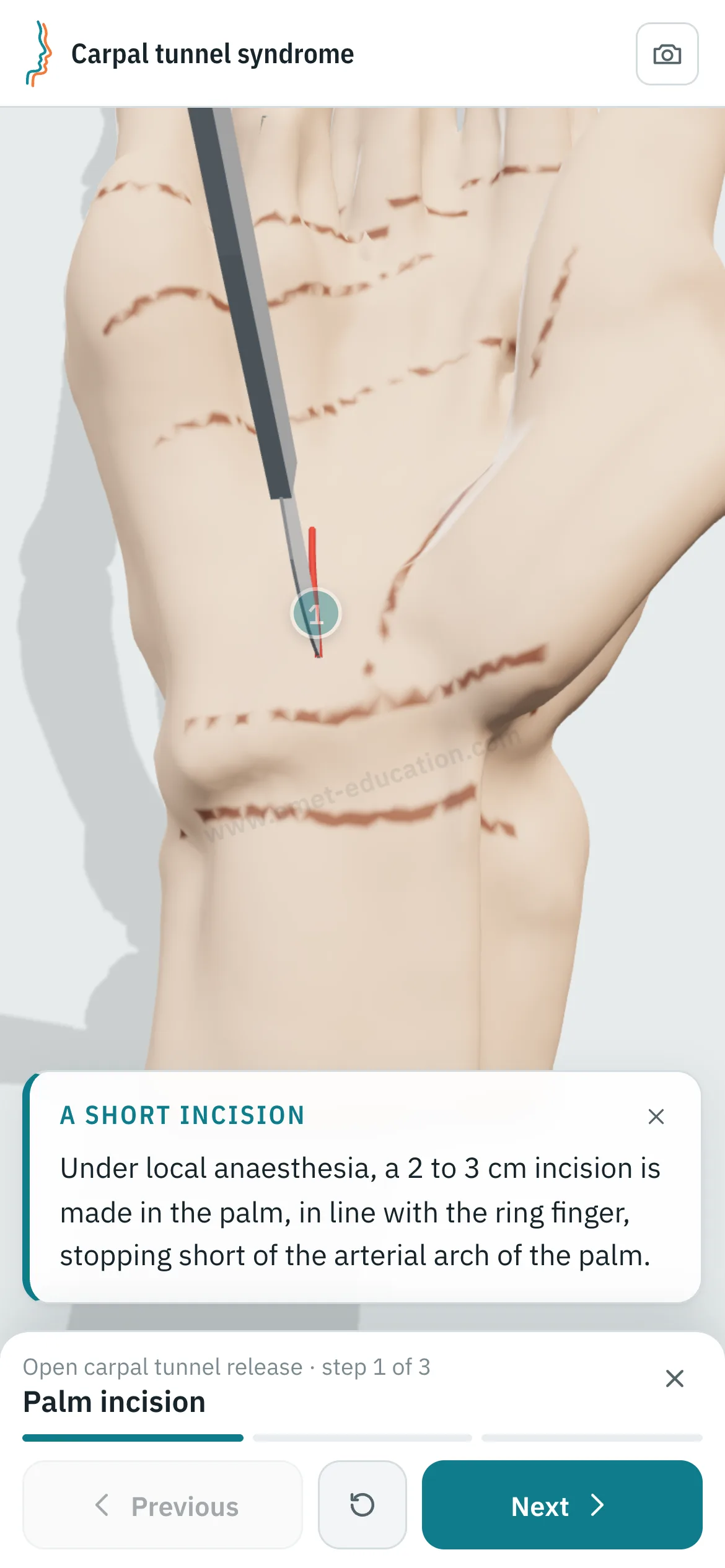 Patient view on a phone: the carpal tunnel release replayed step by step.