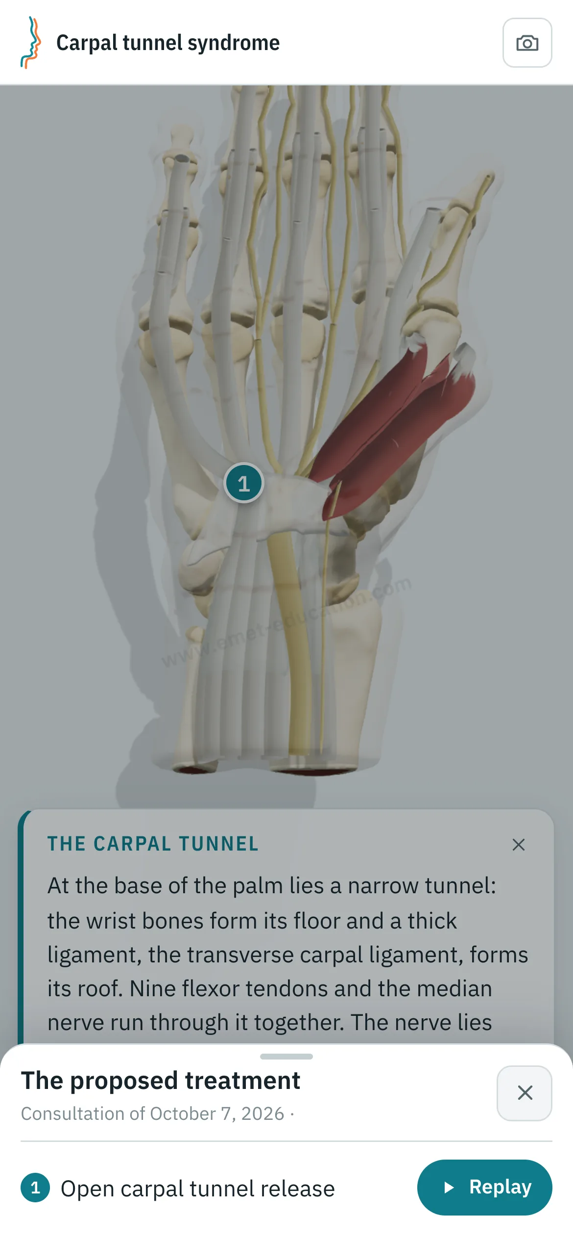 Patient view on a phone: the carpal tunnel after release, and the “The proposed treatment” panel open, with the “Replay” button.