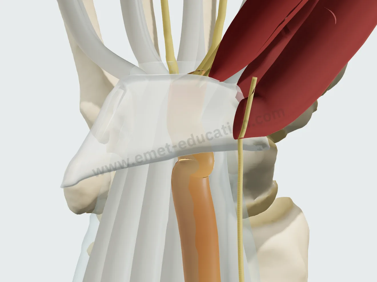 Moderate severity: the nerve flattened under the ligament, swollen and red proximally.