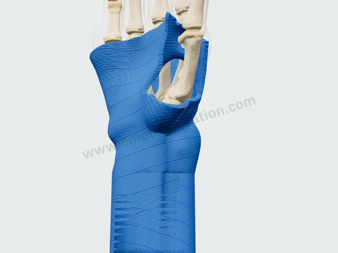 Resin cast, thumb free: the roll wrapped from the forearm to the base of the fingers.