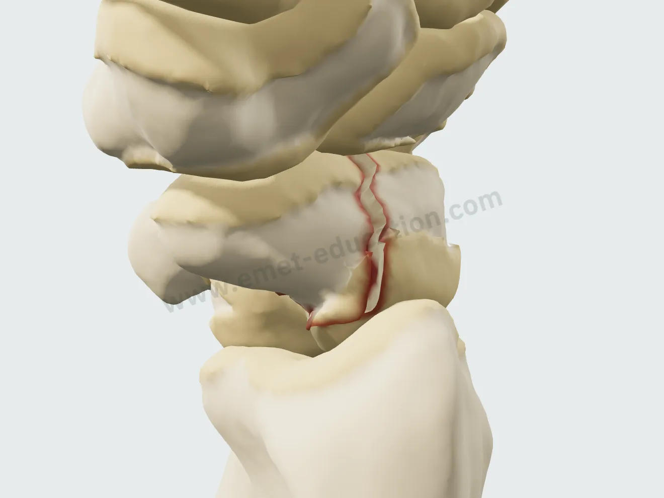 Complete waist fracture: the line crosses the whole bone.