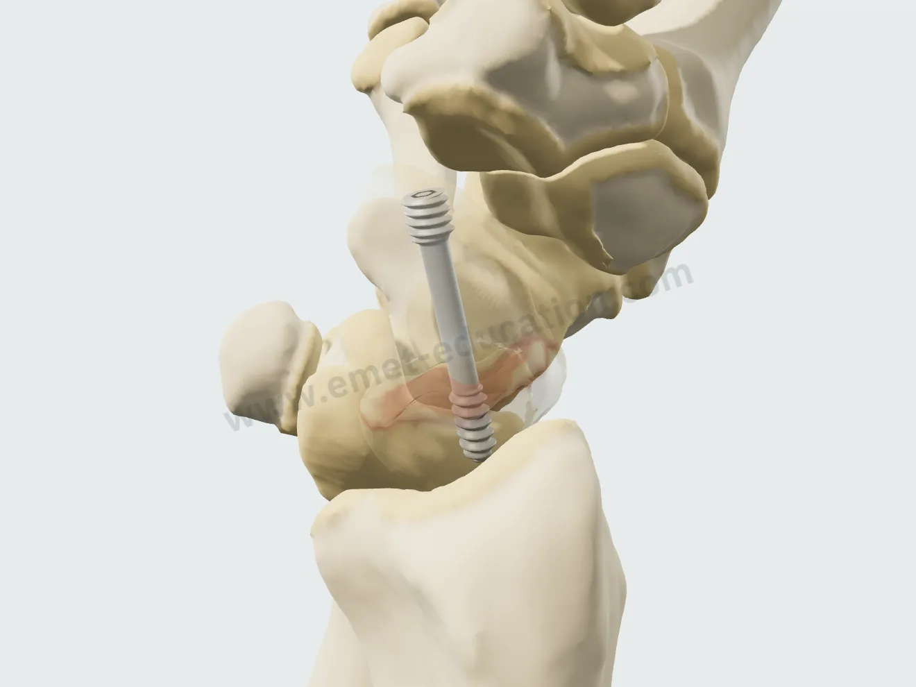 Open reduction, step 4: the wire removed, the screw alone in the bone.