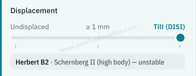 Model panel: three-notch displacement gauge, undisplaced, at least 1 mm, tilt (DISI).