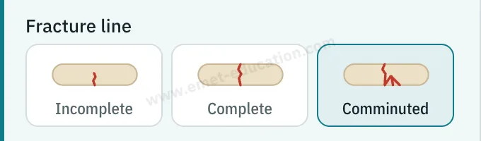 Model panel: incomplete, complete or comminuted fracture line.