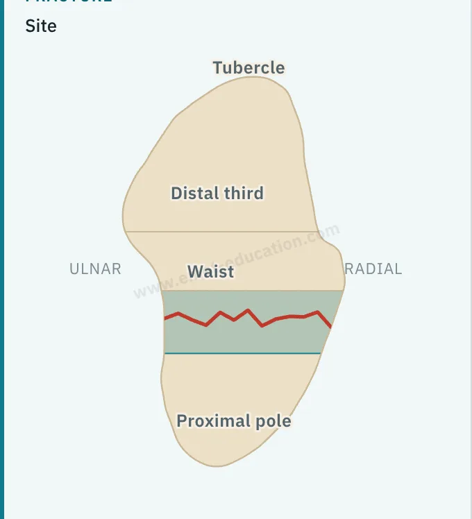 Model panel: clickable diagram of the scaphoid, waist site, Herbert B2 and Schernberg II classification.