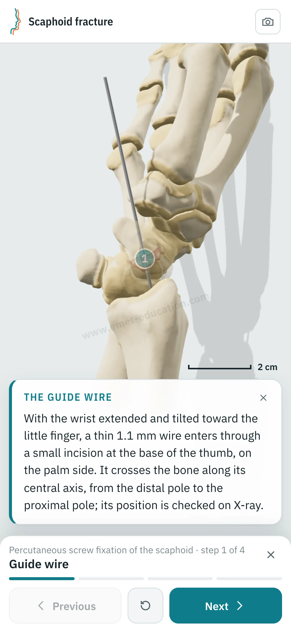 Patient view on a phone: the percutaneous screw fixation replayed step by step.