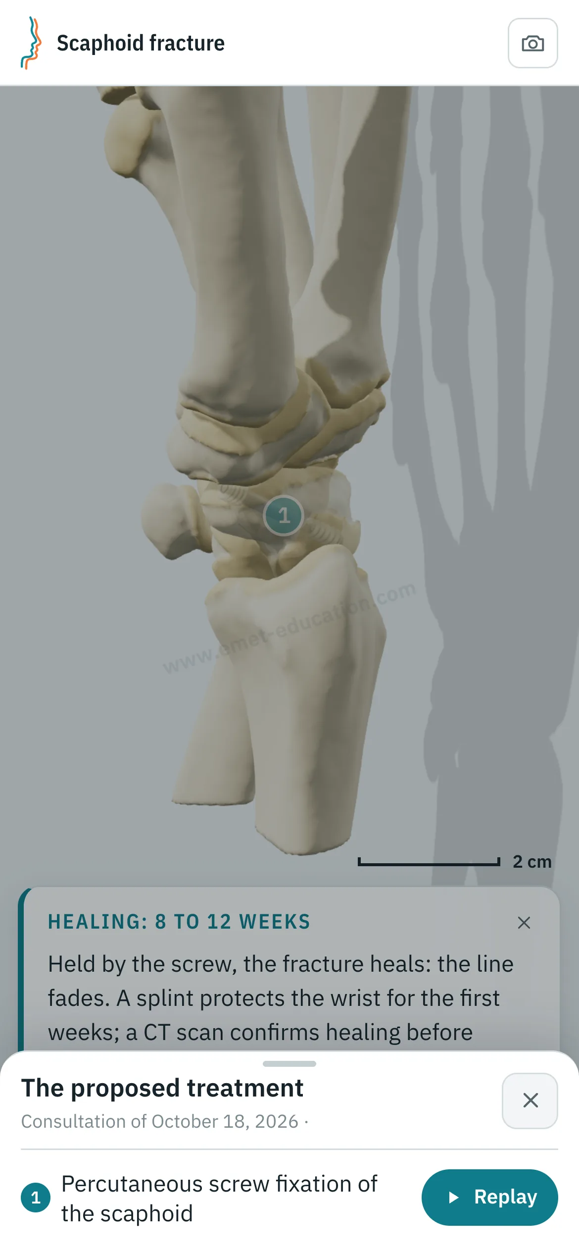 Patient view on a phone: the scaphoid after percutaneous screw fixation, and the “The proposed treatment” panel open, with the “Replay” button.