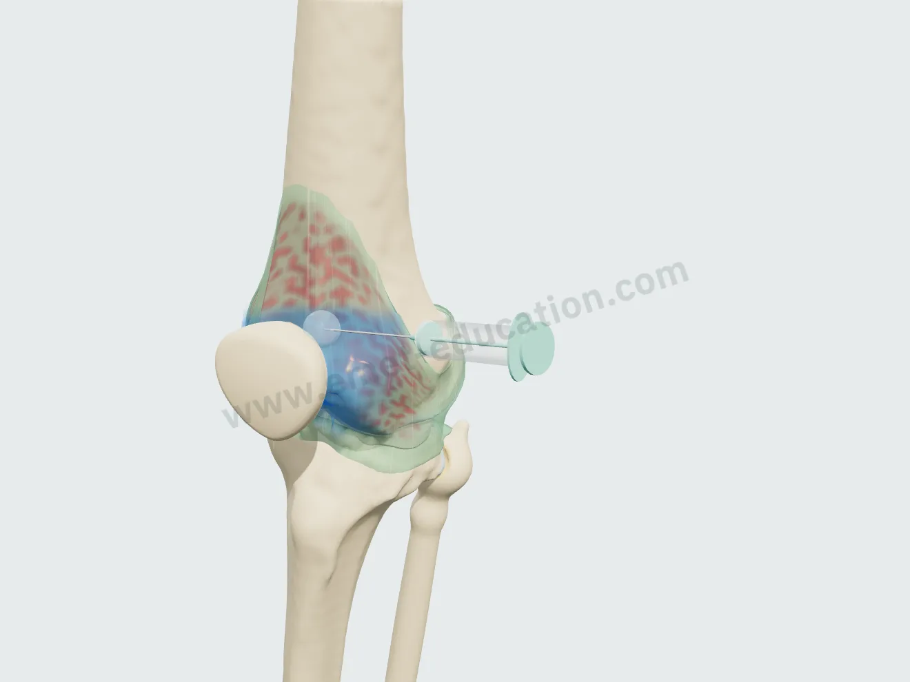 Injection, step 3: bluish corticosteroid cloud in the joint.