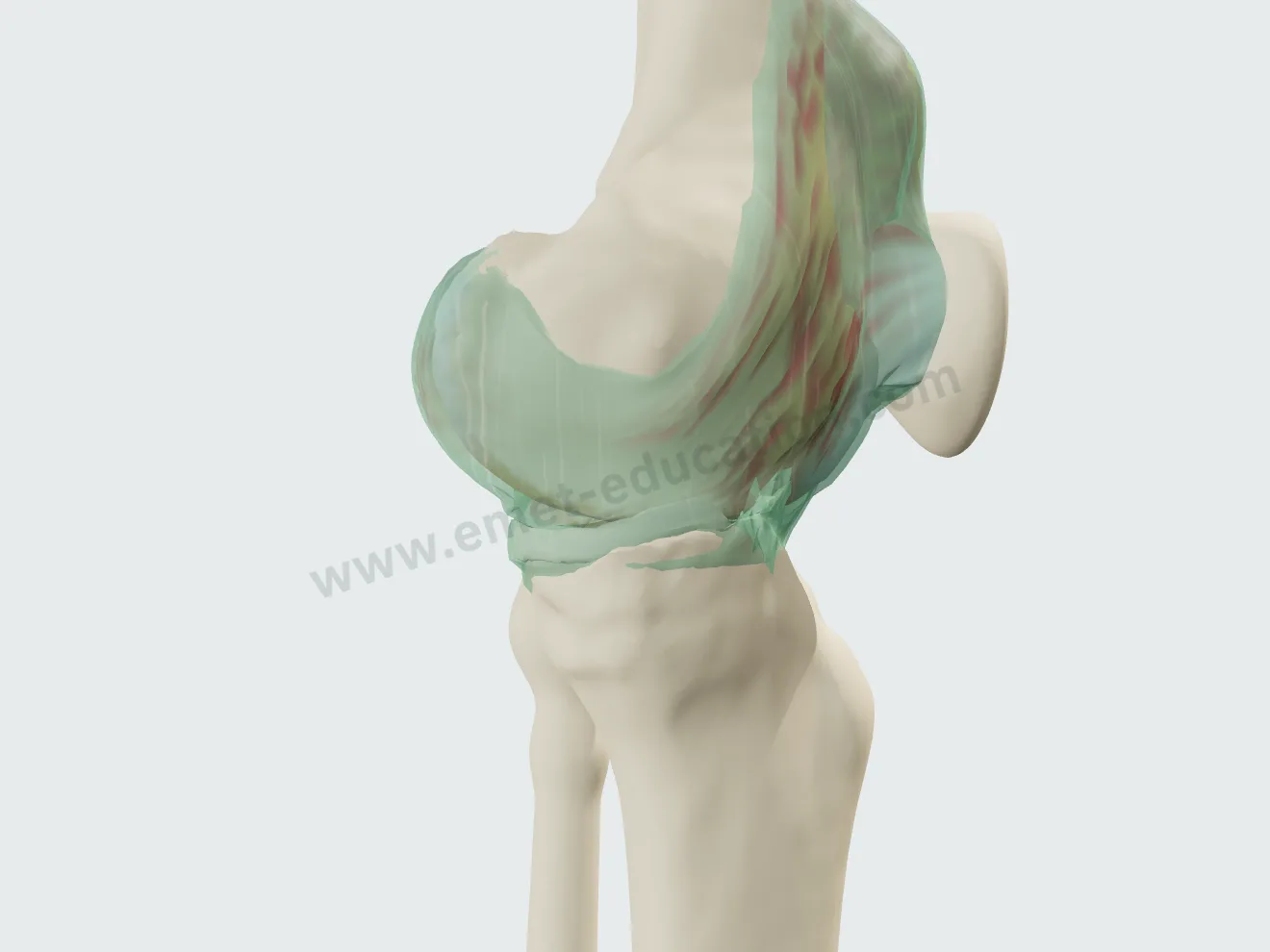 Moderate effusion: distended suprapatellar pouch, red villous synovium.