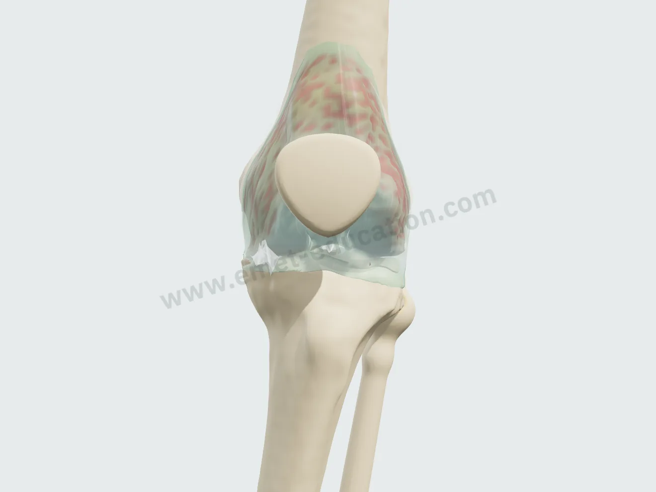 Viscosupplementation, step 4: gel spread in the joint space.